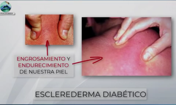 Esclerederma diabetico