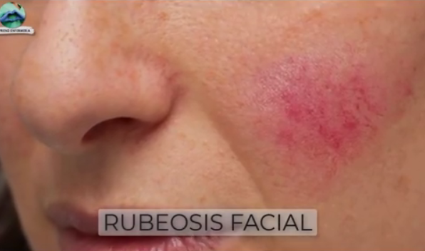 Rubeosis facial